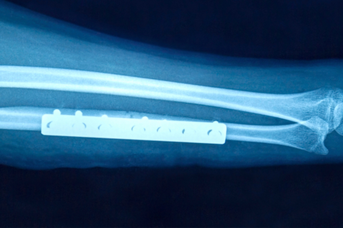 Xray of an arm with a plate and screws